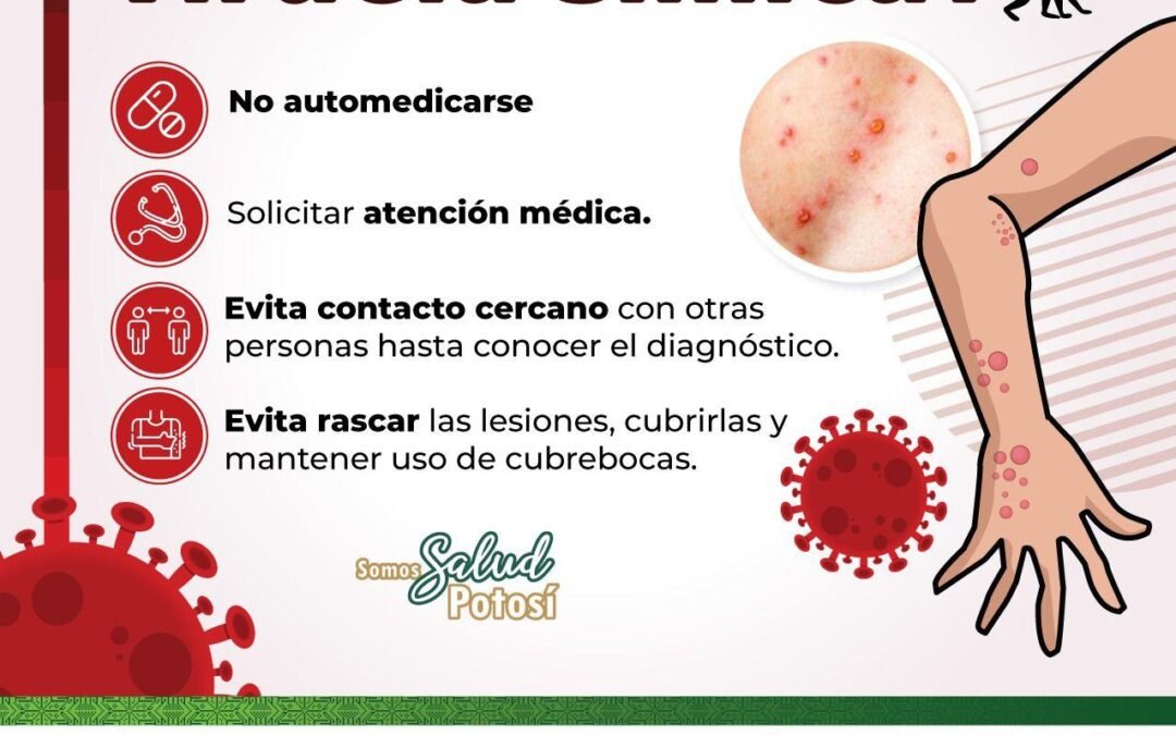 TIENE SLP SOLO UN CASO POSITIVO CONFIRMADO DE VIRUELA SÍMICA