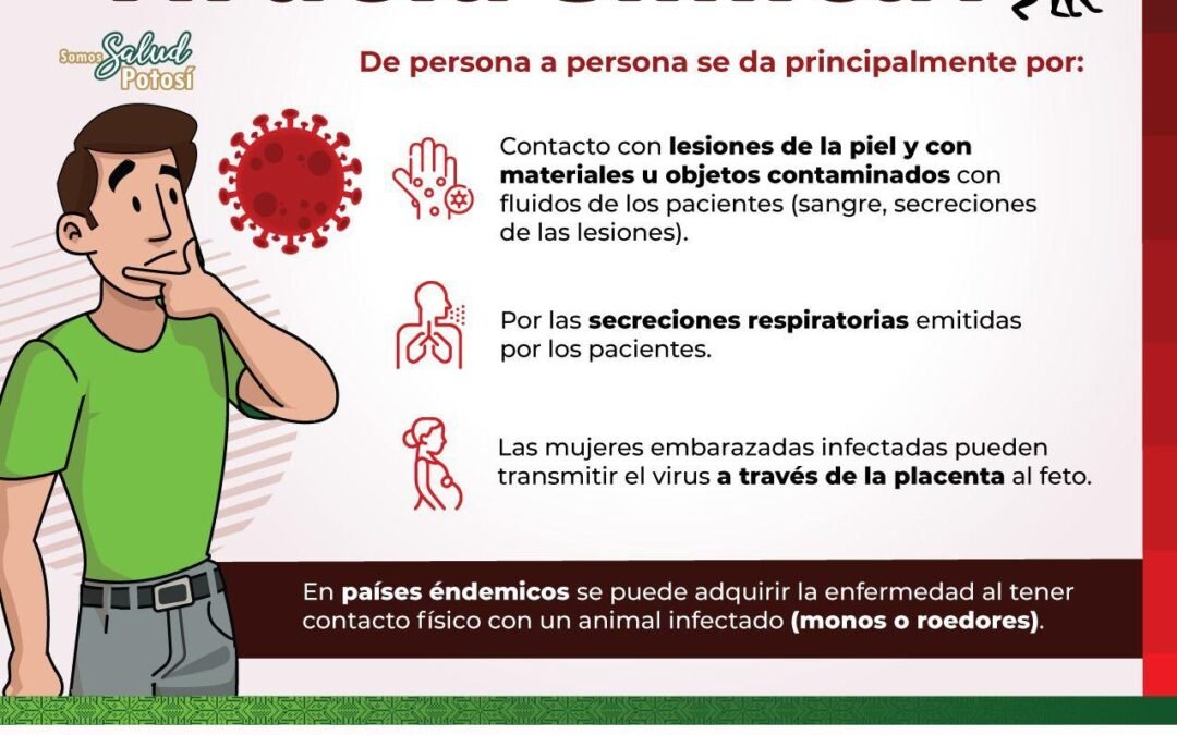 CONFIRMA SALUD UN NUEVO CASO DE VIRUELA SÍMICA EN SLP